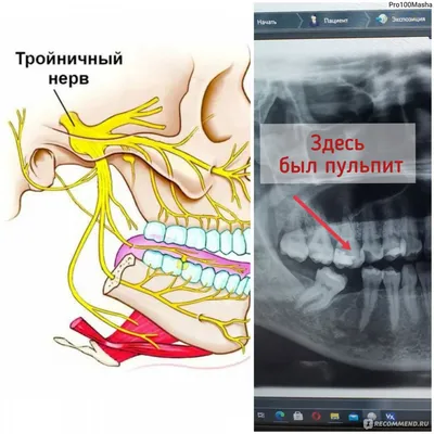 Депульпация (удаление нерва) или эндодонтическое лечение зуба - «Болеть  может только живое и иногда чтобы избавиться от боли приходится удалить  нервный пучок и оставить мертвый зуб. » | отзывы