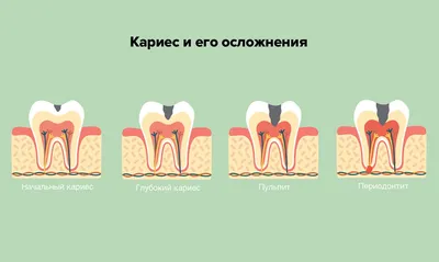 Удаление нерва зуба — современные методики депульпирования на Startsmile.ru