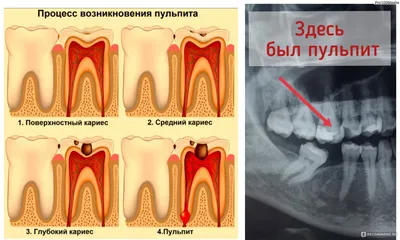 Депульпация (удаление нерва) или эндодонтическое лечение зуба - «Болеть  может только живое и иногда чтобы избавиться от боли приходится удалить  нервный пучок и оставить мертвый зуб. » | отзывы