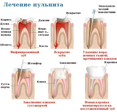 Мышьяк в зубе 7 дней. Зачем используется мышьяк в стоматологии и не вредит  ли он здоровью