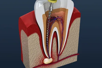 Удаление нерва зуба цена в Москве: удаление зубного нерва | Atlantis Dental