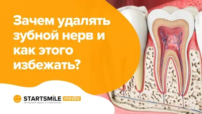 Удаление нерва зуба — современные методики депульпирования на Startsmile.ru