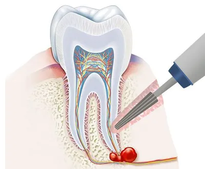 Воспаление корня зуба: ✔️лечение ✔️этапы ✔️профилактика | Denten.by