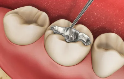 Временная пломба — Центр Стоматологии и Имплантации БАБТА