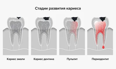 Периодонтит - что это, классификация, причины развития, симптомы,  осложнение, диагностика и лечение