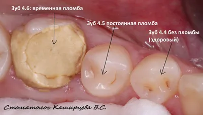 Мышьяк в зубе фото