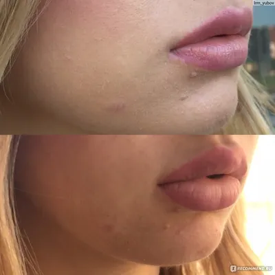 Гиалуроновая кислота Juvederm Ultra 3 - «Увеличение губ препаратом Juvederm  Ultra 3, натуральный эффект + коррекция носогубных складок, мой подробный  отзыв + много фото ДО и ПОСЛЕ » | отзывы