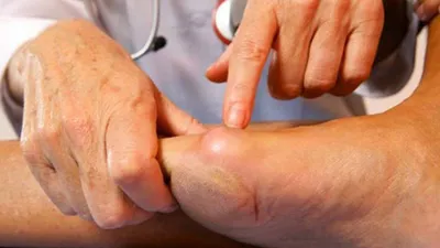 Чем опасна шишка на ноге? - Первая Медицинская Клиника