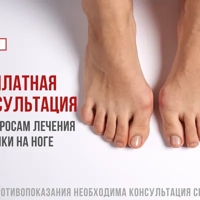 Косточки» на ногах: как избавиться от боли и дискомфорта - KP.RU