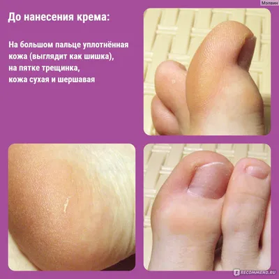 Крем для ног Natura Kamchatka by Natura Siberica Смягчающий \"Полярный  цветок\" - «Просто обычный крем в красивом тюбике. Ни какой разницы.  Внимание: фото ног!» | отзывы