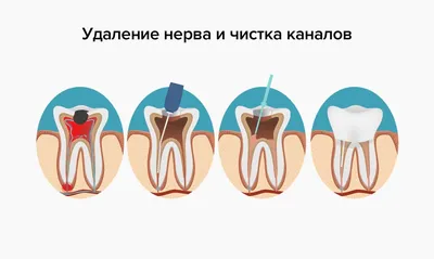 Болит зуб после удаления нерва и чистки каналов — что делать в статье на  Startsmile.ru