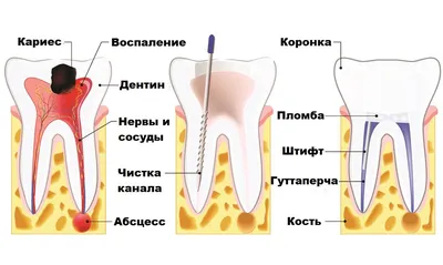 Болит зуб после удаления нерва: причины и что делать? - Underson Clinic