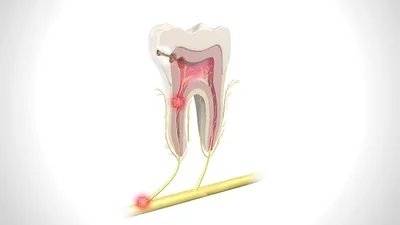 Зачем нужны нервы в зубе, как успокоить боль? – Стоматология «АльфаДент» в  Оренбурге
