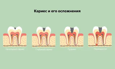 В каких случаях из зуба удаляют нерв?» — Яндекс Кью