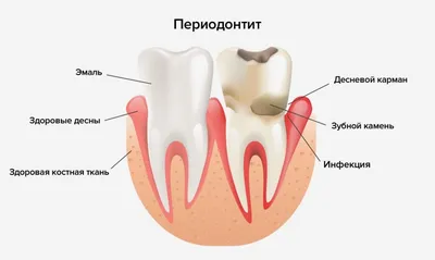 Лечение периодонтита Эд Дент Стоматологическая клиника г. Кольчугино