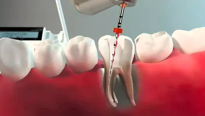 Удаление нерва зуба | Ростов-на-Дону