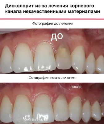 Что делать если потемнел зуб | Причины черноты на зубах