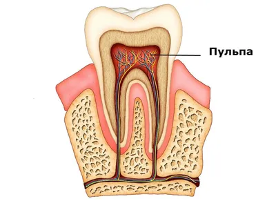 Зачем покрывать коронкой депульпированный зуб