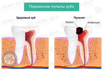 Удаление [1 Зубного Нерва] Как Удаляют Из Зуба ЛюмиДент Достают Вырывают  Убирают