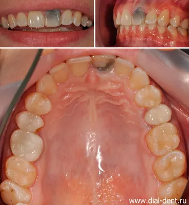 Передний зуб потемнел – что делать?
