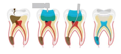 Удаление нерва зуба в Санкт-Петербурге: цены в клинике «Два Дантиста»
