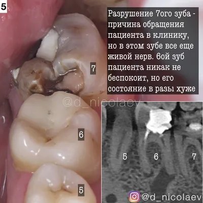 Что такое периодонтит - Доказательная медицина для всех