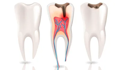 Как лечат глубокий кариес без удаления нерва? - энциклопедия Ochkov.net