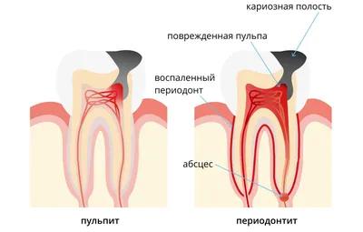 Лечение пульпита в Сочи, цены в стоматологии Аврора