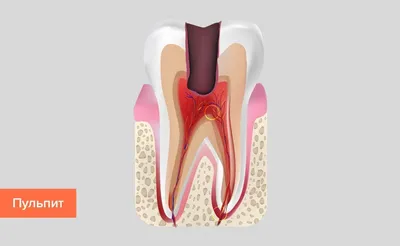 Лечение от пульпита