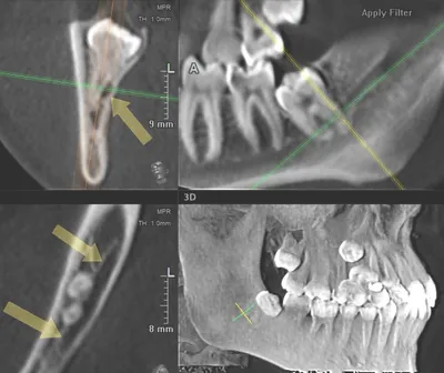 3D диагностика и принципы визуализации 3-х моляров нижней челюсти