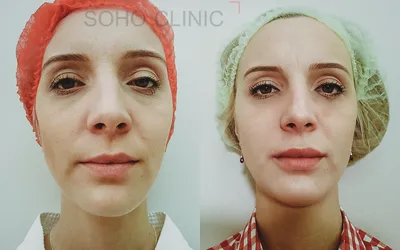 Увеличение губ гиалуроновой кислотой фото до и после — Sohoclinic