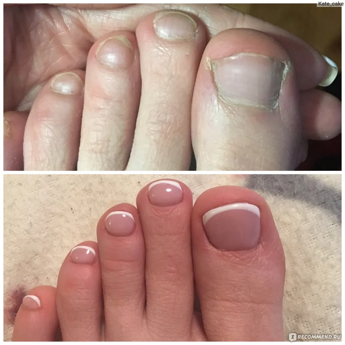 Педикюр до и после. Неухоженные женские ногти.