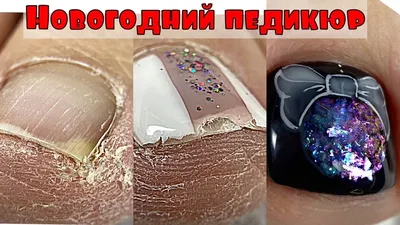 Педикюр на сухих ногах💅 Как вычистить подногтевую мозоль💅 Новогодний  дизайн ногтей на ногах - YouTube