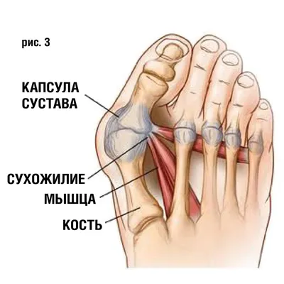 Удаление косточек на ногах, шишек на ногах в Краснодаре