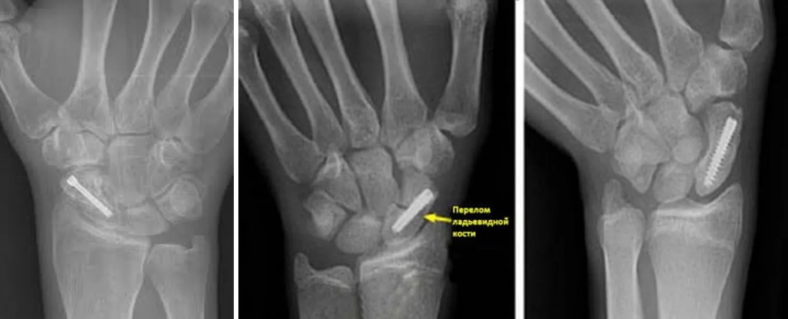 Ладьевидная кость лучезапястного сустава. Ложный сустав ладьевидной кости. Перелом ладьевидной кости стопы рентген. Ладьевидная кость руки перелом.
