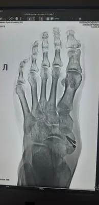 Повторный перелом ладьевидной кости стопы - Вопрос ортопеду-травматологу -  03 Онлайн