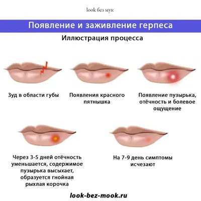 Герпес после перманентного макияжа губ - look без мук