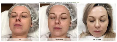 Химический пилинг – сделать химический пилинг по доступной цене в клинике  лазерной хирургии и косметологии «Вектор» в Москве