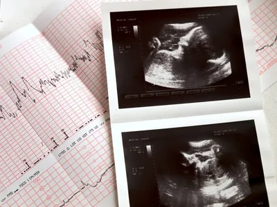 32 неделя беременности от зачатия: УЗИ плода, фото живота, что происходит с  мамой и малышом
