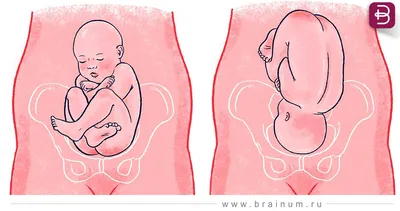 Карта беременного живота\". Идеальное положение ребенка и как его изменить.  - Brainum