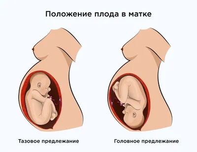 Тазовое предлежание: когда диагностируется и что делать?