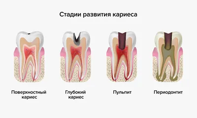 Лечение кариеса зубов в Петрозаводске, цены на лечение кариеса у детей и  взрослых