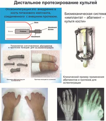 Центр Илизарова: Курганские ученые разрабатывают экспресс-имплантацию при  утрате пальцев
