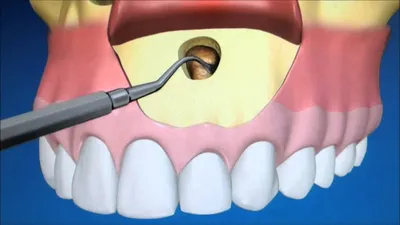 🦷 Резекция верхушки корня зуба в Московском | Показания и цена проведения  стоматологической операции