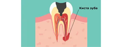 Кисты» зубов – всегда ли приговор?