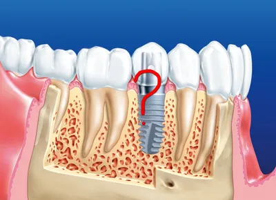 Что делать, если после установки штифта болит зуб | Зубная Фея
