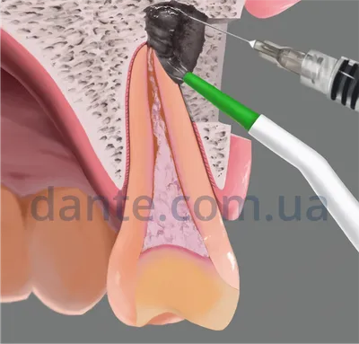 ≡ Резекция верхушки корня зуба в Киеве — метро Олимпийская: цены и отзывы о  клинике D.Ante