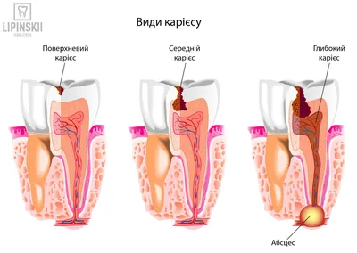 Резекция верхушки корня - стоимость услуги Хирургия в стоматологии в Киеве,  Резекция верхушки корня - цена в стоматологии lipinskii.com.ua