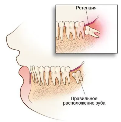 Ретинированные зубы - причины, последствия, способы лечения и показания к  удалению | НАВА