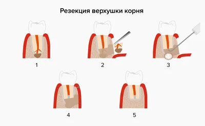 Апикальная микрохирургия в стоматологии: показания, виды и этапы  зубосохраняющих операций